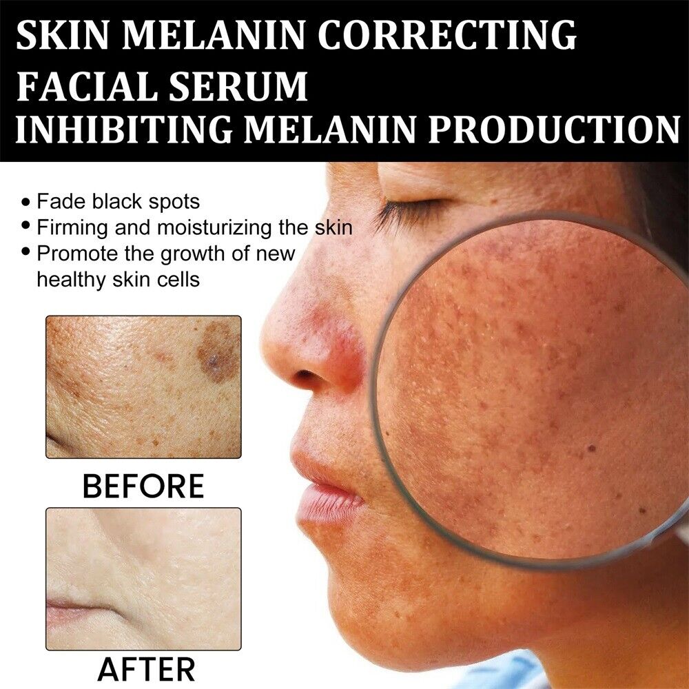 🌞 SUMMER BLOWOUT! 80% OFF! 🔥 LAST DAY!)✨Fast Dark Spot Remover-LOVILDS™ Melanin Correcting Facial Serum